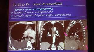 05 Neoplasie della Pleura Lo staging del mesotelioma mediante imaging Maria Luigia Storto [upl. by Nosemyaj]