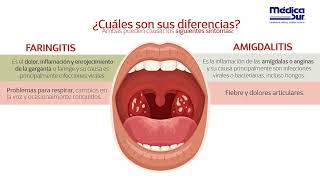 Diferencias entre faringitis y amigdalitis [upl. by Nazar]