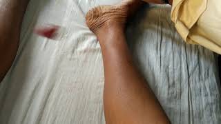 Hypothyroidism Woltmans sign Delayed relaxation of bilateral ankle jerk Myxoedema [upl. by Irelav]