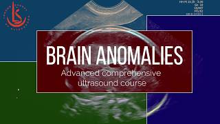 Fetal Neurosonography Brain development and CNS anomalies [upl. by Doloritas]