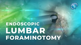 What is Endoscopic Lumbar Foraminotomy [upl. by Sherie]