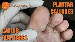 Plantar calluses Podología Integral podologiaintegral [upl. by Hightower]