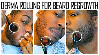 Microneedling for Beard Growth  30 Day Results [upl. by Lamag]