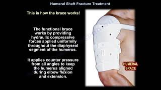 Humeral Shaft Fracture Treatment  Everything You Need To Know  Dr Nabil Ebraheim [upl. by Nivrae575]