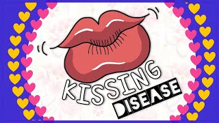 Infectious mononucleosis Kissing disease Diagnosis Clinical feature Treatment [upl. by Pedersen]