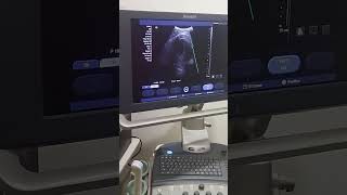 Echo test for heart  cardiogram shortvideo cardiography Echo hearttouchingstory shortstatus [upl. by Jorey]