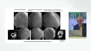 Calcium Debulking Strategy using Rotational Atherectomy by Dr Imad Sheiban [upl. by Anemolif409]