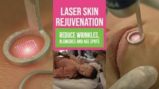 Reduce Wrinkles Blemishes and Age Spots with Laser  Body Details [upl. by Min]