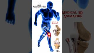 ACL Reconstruction medical animation 3d short Biology with Aliya [upl. by Aklam169]