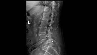 Bone tumor lumbar spine MRI versus xray  First Look MRI [upl. by Raychel]