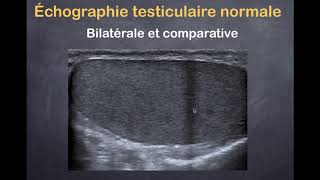 Tumeurs du testicule  1 Imagerie normale [upl. by Madeleine]