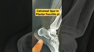 Calcaneal Spur In Plantar Fasciitis ptDr Sai Chandra [upl. by Grossman]