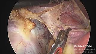 Fibroid Uterus with Dermoid Cyst [upl. by Naujik]