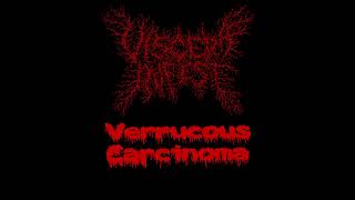 Verrucous Carcinoma Stage IV  Viscera infest [upl. by Ayar853]