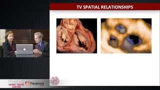 Echocardiographic Approach to the Tricuspid Valve 3D Echo 360 Conference [upl. by Hildegard]