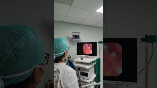 Bronchoscopy or bronkoskopi part 3 [upl. by Ialda]