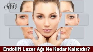 Endolift Lazer Ağı Ne Kadar Kalıcıdır [upl. by Tigges]