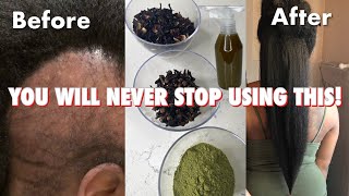 do not USE this hair treatment if you’re not ready for Extreme HAIR growth [upl. by Ahsinac]