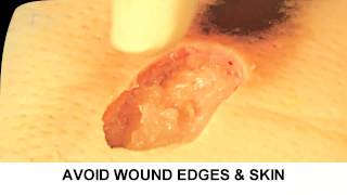 Enzymatic Debridement Demonstration Understand Wound Care [upl. by Cindi698]