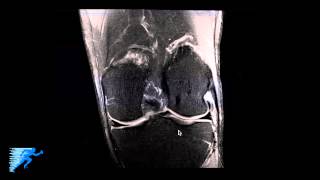 How to Read Knee MRI of Normal Knee  Anatomy of the Knee  Complex Knee Surgeon  Minneapolis  MN [upl. by Zechariah]