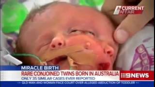 Miracle conjoined twins die shy of three weeks  Baby with two faces dies [upl. by Akenna]