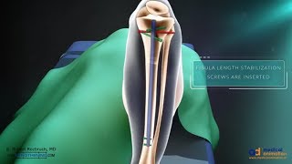 Precice Tibia Lengthening Surgical Animation [upl. by Arrej761]