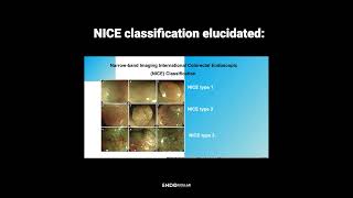 Endoscopic Identifications Key Tips for Differentiating Polyps [upl. by Ellertnom]