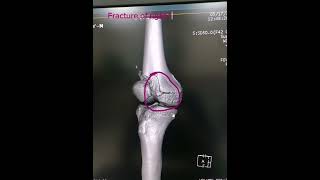 CT Scan of Right leg  Medical Imaging  Dr Green Side  Fracture of leg seen on CT  CT Scan [upl. by Enaht]