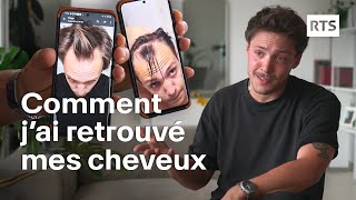 Les greffes de cheveux séduisent de plus en plus face à la calvitie  RTS [upl. by Anirtik106]