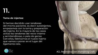 Reconstrucción de ligamento cruzado anterior [upl. by Fina]