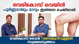 വെരികോസ് വൈൻ പൂർണമായും മാറും ഇങ്ങനെ ചെയ്താൽ  Varicose veins malayalam  Arogyam [upl. by Divan725]