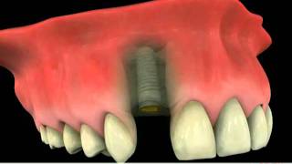 Implant versus Dental Bridge  Which Is More Reliable [upl. by Struve]