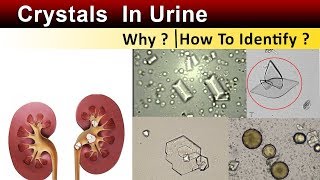 Crystals In Urine  Why amp How to Identify [upl. by Annawot]