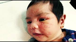 Neonatal cephalic pustulosis mimicking Neonatal Acne Erythema toxicum [upl. by Yatnuahs]