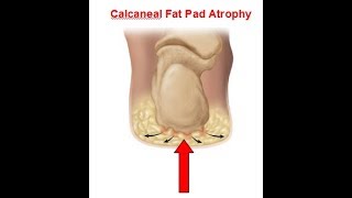 Calcaneal fat pad atrophyWhat is it and what does it look like [upl. by Atiken532]