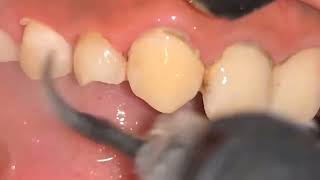 ASMR Teeth Cleaning  BEFOREAFTER Deep Dental Tartar amp Calculus Removal [upl. by Meekyh]