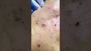 Blackheads Removal  Acne Treatment and Very Satisfying Satisfying Pimple pop blackheads [upl. by Femmine]