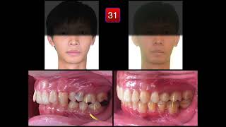 Ankylosis Case Analysis｜【Chris Chang Ortho】CC775 [upl. by Ssur]