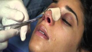 The Kotler Nasal Airway  Removal of the Airway [upl. by Rammaj]