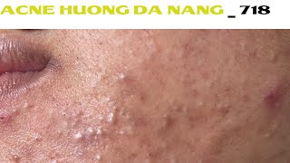 Acne Treatment Huong Da Nang 718  Remove Blackheads [upl. by Aicele]