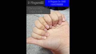 Major polydactyly 9 fingers on one hand [upl. by Annaeerb902]