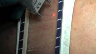 ENG  Varicose Veins treatment with Multidiode Endo Laser [upl. by Hippel563]