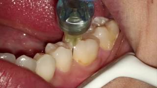 Endodontia de Molar Inferior [upl. by Deland785]