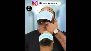 Grade 7 Baldness resolve I 4 Month hair transplant result I Resolve donor area beardo iftclinic [upl. by Tressa]