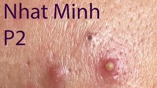 Acne Treatment Huong Da Nang 029  Treatment for Nhat Minh Part 2 [upl. by Dawson]