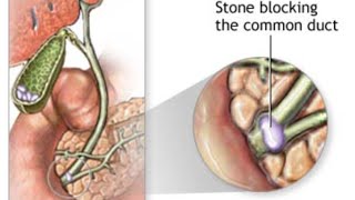 Choledocholithiasis amp Cholangitis [upl. by Wolbrom903]