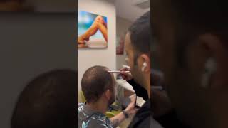 Vip Hair Transplant Operations by Doctor in Turkey [upl. by Melosa919]