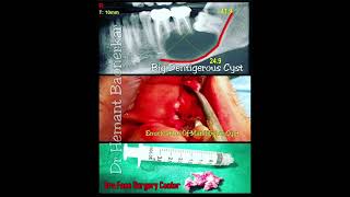 Dentigerous Cyst Case Report [upl. by Lenoj]