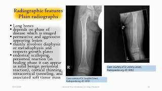 LangerhansCell Histiocytosis of the bone  ‘‘The great mimmicker’’ [upl. by Naeroled]