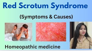 Red Scrotum Syndrome treatment  Red Scrotum Syndrome RSS symptomscauses amp homeopathic medicine [upl. by Assirral]